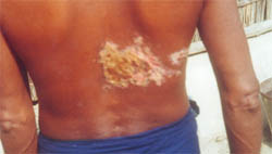 vesicular eruptions