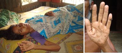 Victim of arsenicosis Asia Begum counts her days at her village home in Magura as doctors recently detected malignancy in her liver, right, hand of an arsenic victim at Hogoldanga village in the district.