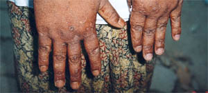 infected hands