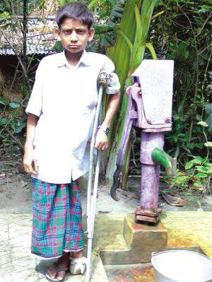 a gangrene patient, simon, noakhali